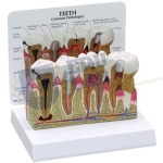 Human Teeth Model - Dental Problems